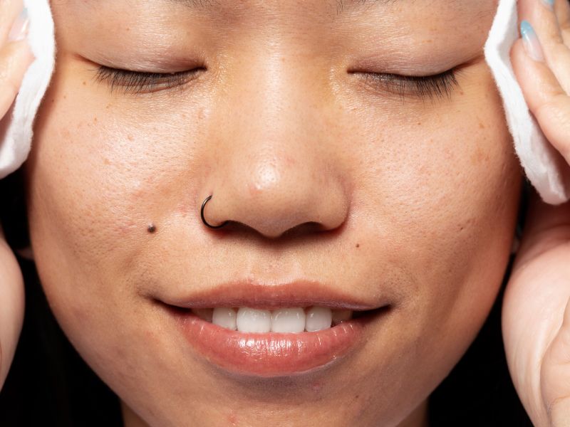 Cara Menghilangkan Jerawat Mendem: Cek Treatment Paling Ampuh!
