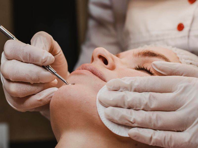 acne facial treatment