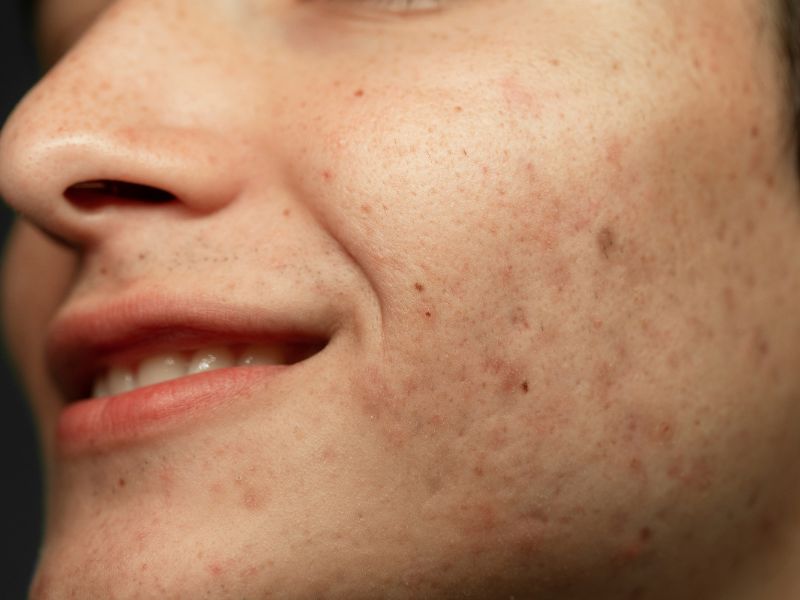 cara menghilangkan fungal acne