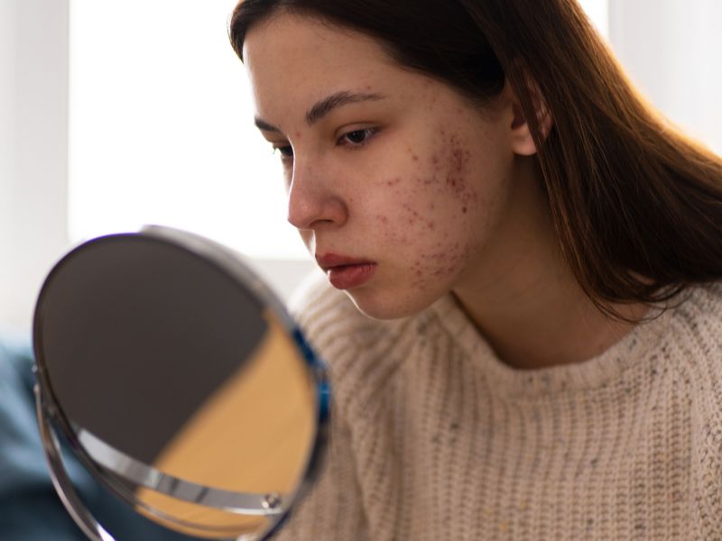 jerawat parah enaknya treatment apa