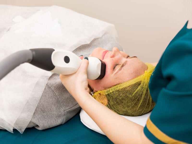 ipl treatment
