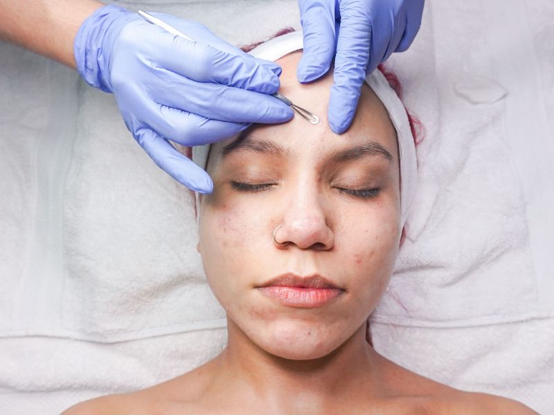 treatment membersihkan komedo